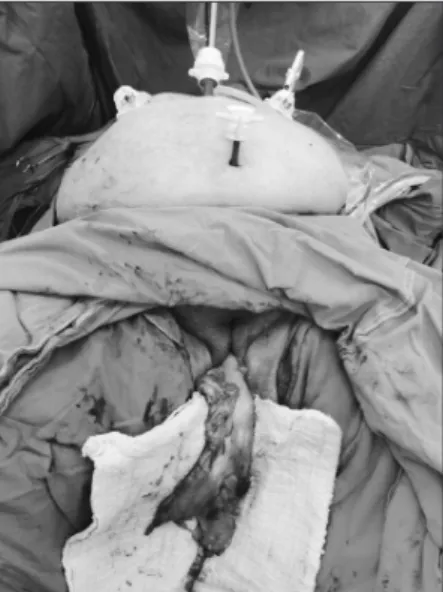 Fig. 2. View of specimen including subtotal gastrectomy, omentectomy,  and D2 lymph node dissection.