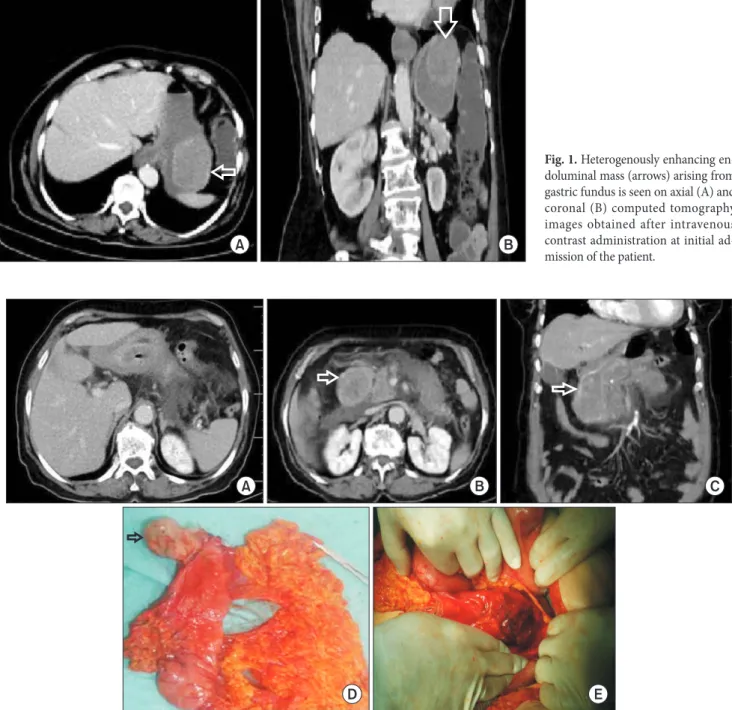 Fig. 2. (A) Gastroduedonal intussusception. (B, C) The mass protruding to the duedonum and causing obstruction (arrows)