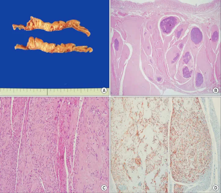 Fig. 3. Pathologic findings. (A) Gross resection of the tumor revealed a solid, whitish-yellow  parenchyma with multifocal diffuse calcifications (cut  section of gastrointestinal stromal tumor)