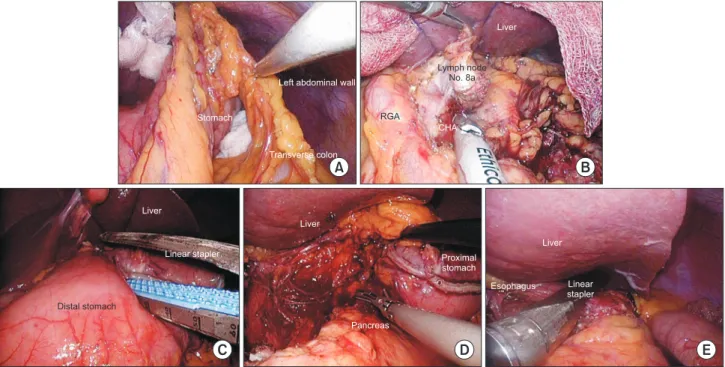 Fig. 1. The procedures during lymph node dissection. (A) Opening of the lesser sac. (B) Lymph node station No