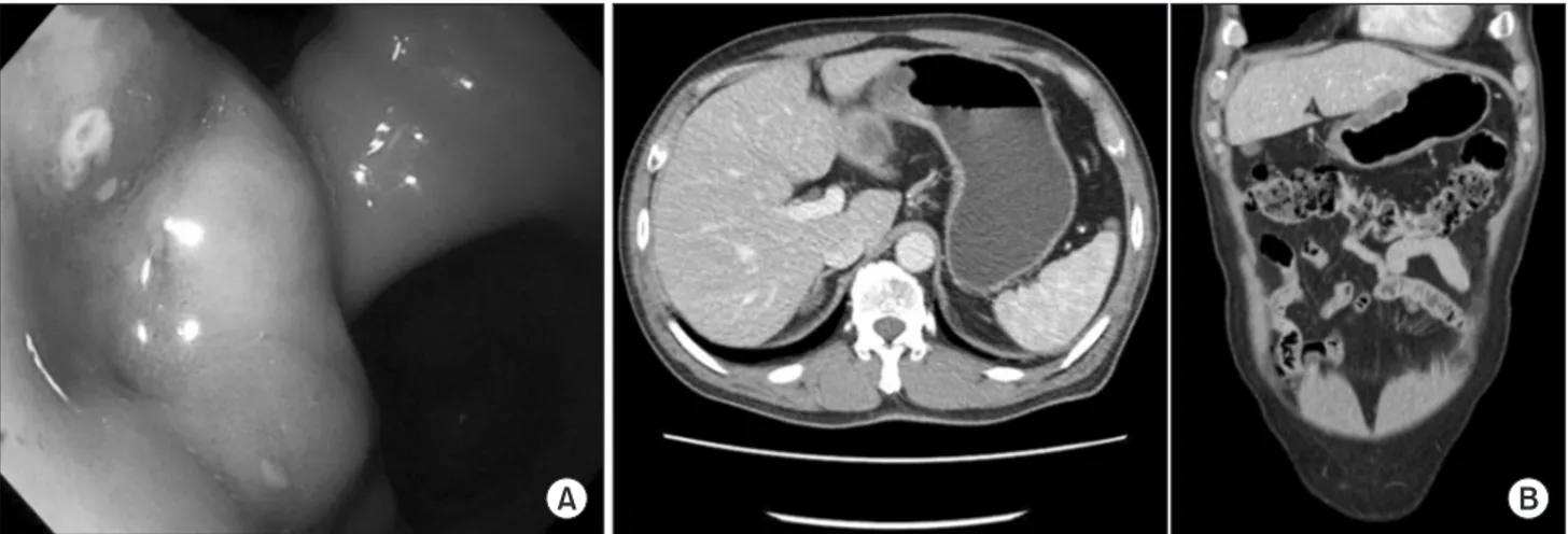 Fig. 3. (A) A large protruding ulcerative mass originating from the submucosa at the anterior wall of the lower body of the stomach and a single  small raised erosion at the cardia