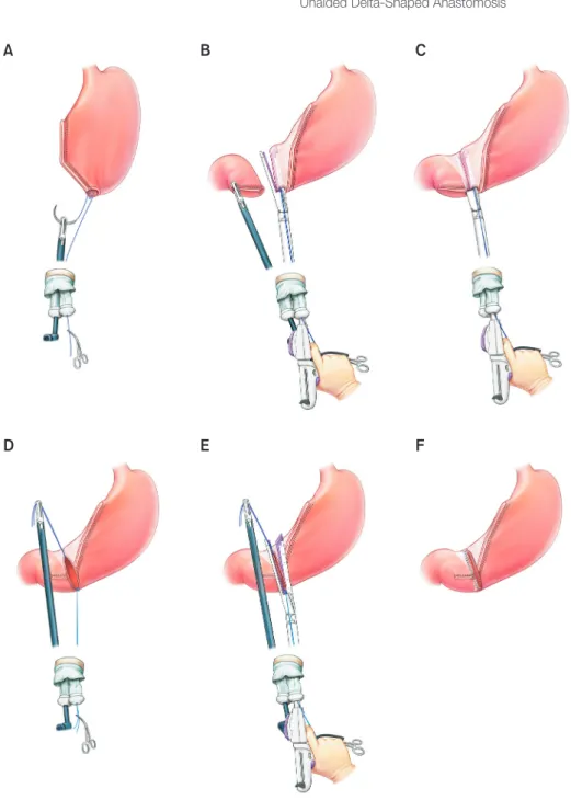 Fig. 1. Unaided delta-shaped anas- anas-tomosis. (A) A traction suture with  3/0 monofilament thread is added at  the posterior wall of the small  inci-sion hole of the remnant stomach and  pulled out through a single umbilical  port