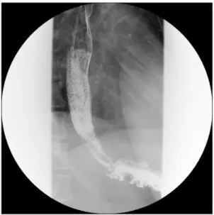 Fig. 1. Preoperative barium swallow showing retention of contrast flow  at the distal esophagus with esophageal dilatation.
