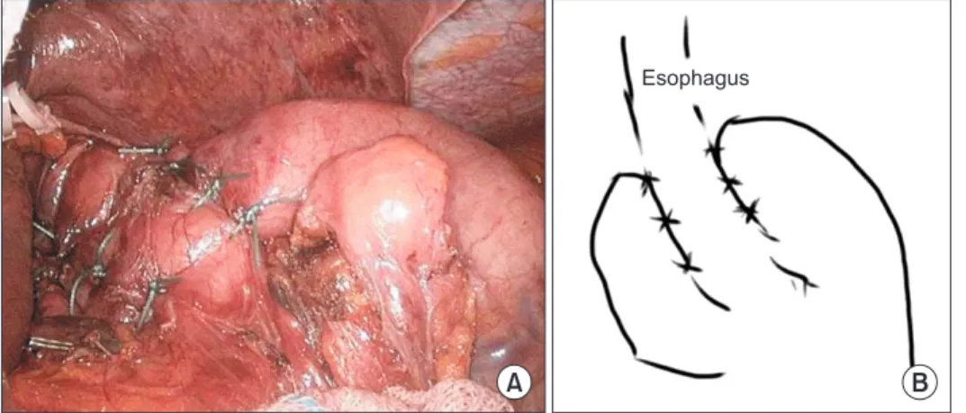 Fig. 4. Intraoperative photograph of  completion of the Toupet  fundoplica-tion (A) and schematic (B)