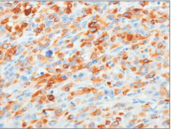 Fig. 2. The tumor displayed spindle tumor cells forming an interlacing 
