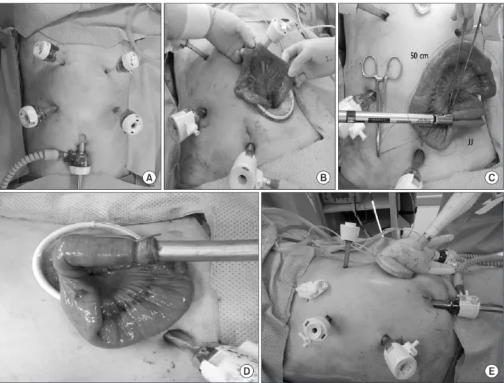Fig. 1. Trocar locations and extracorporeal procedures for laparoscopic total gastrectomy