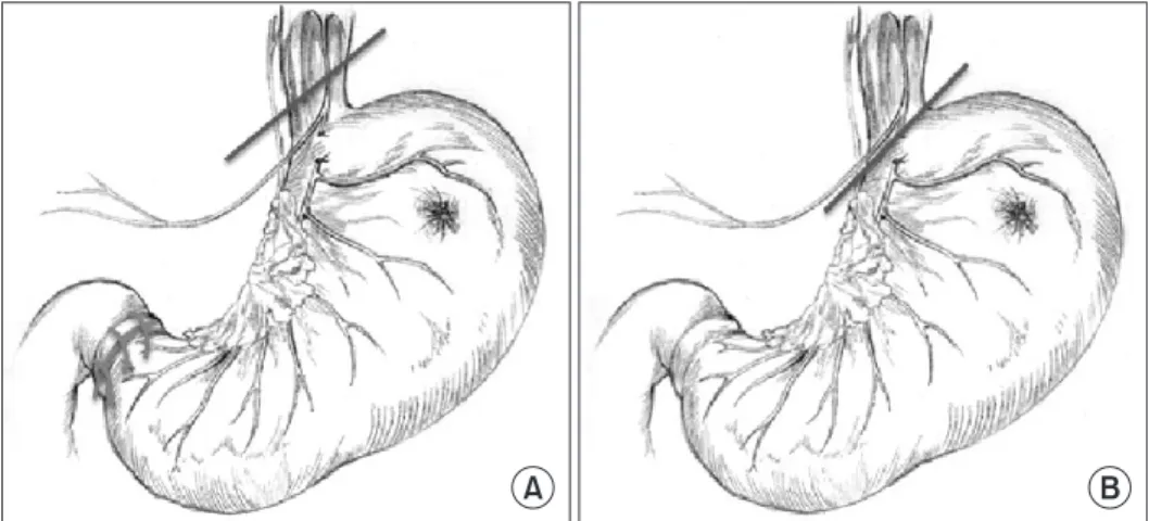 Fig. 1. Differences between conven- conven-tional proximal gastrectomy (PG) and  modified laparoscopy-assisted PG  (mLAPG)