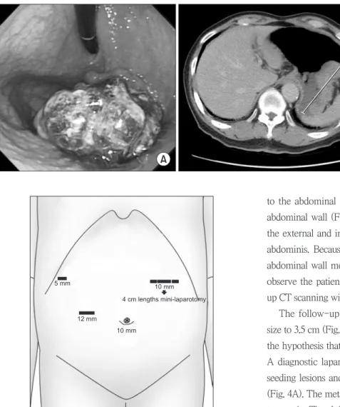 Fig. 2. Port placements for the laparoscopy-assisted total gastrectomy.