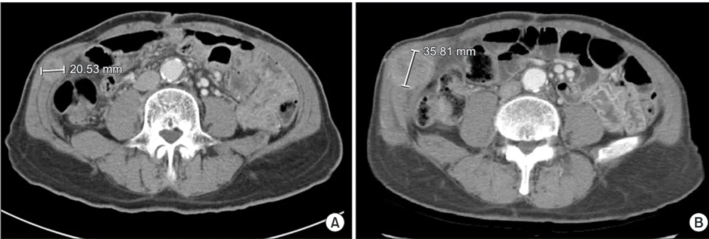 Fig. 4. (A) Diagnostic laparoscopy  re vealed no peritoneal metastasis or  peritoneal invasion of the recurrent  mass