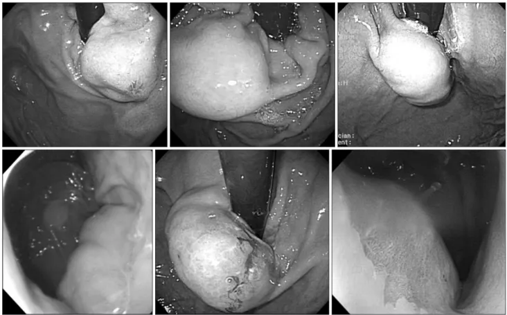 Fig. 1. Preoperative endoscopic findings.