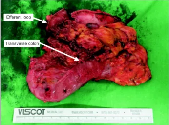 Fig. 1. Direct invasion of the efferent loop and transverse colon from  remnant gastric cancer.