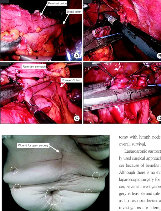 Fig. 4. Wounds of troca sites pictured in dotted white circles.