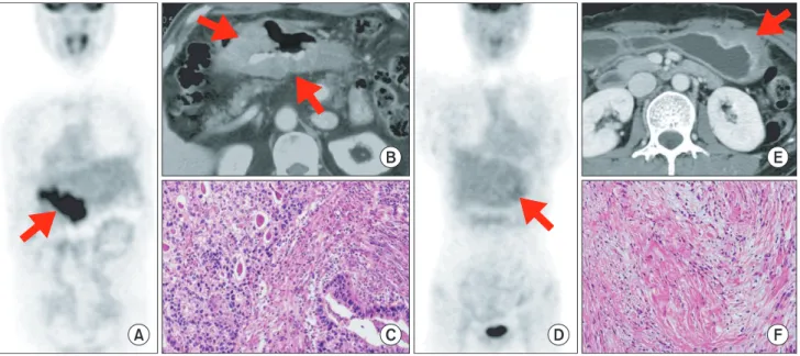 Fig. 1. Histopathologic factors affecting fluorodeoxyglucose (FDG) uptake in advanced gastric cancers (AGCs)