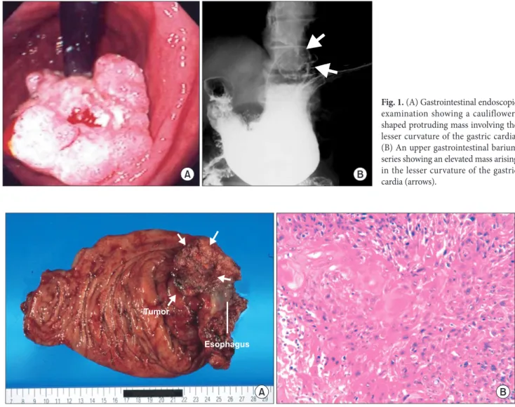 Fig. 2. A computed tomography showing a heterogeneous mass ap- ap-proximately 5.0 cm in diameter arising in the gastric cardia (arrows).