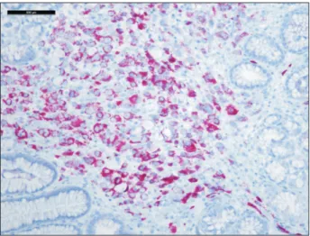 Fig. 5. Tumor cells positive for prostatic specific antigen and alpha  methyl acyl coenzyme A racemase (P504S) (Immunochemical stains,  scale bar 500 mm).