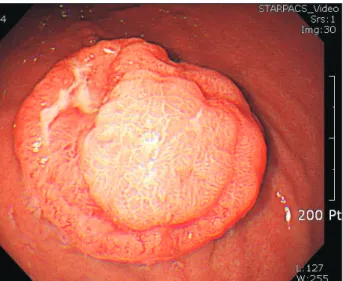 Fig. 2. Computed tomography showed a focal enhancing wall thicken- thicken-ing in the greater curvature of the upper body of the stomach