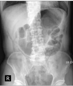 Fig. 1. Localization of the location of the tumor. After clipping with  endoscopy, preoperative abdomen X-ray was performed.