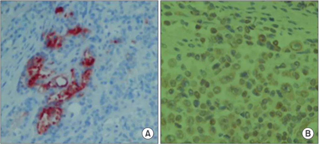 Fig. 5. Carcinoma nests stain (×400). 
