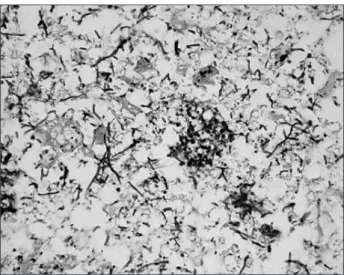 Fig. 3. Pyogenic micro-liver abscesses (H&amp;E stain, ×200). Abscesses  were consisted with bacteria and fungi.