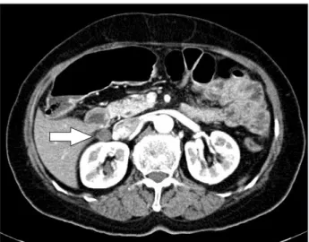 Fig. 2. Intra operative image. Oval shaped mass (arrow) was located  between duodenum (D) and inferior vena cava (V).