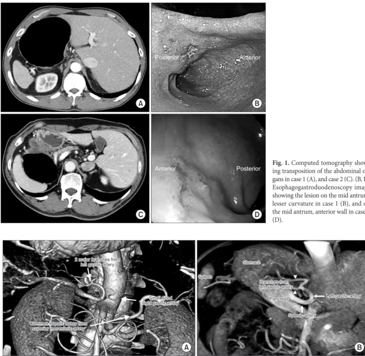 Fig. 1. Computed tomography show- show-ing transposition of the abdominal  or-gans in case 1 (A), and case 2 (C)