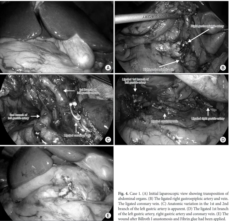 Fig. 4. Case 1. (A) Initial laparoscopic view showing transposition of  abdominal organs