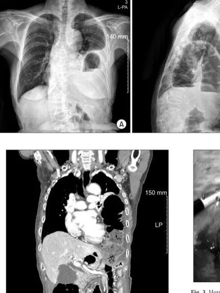 Fig. 2. Coronal section of the chest computed tomogram showed her- her-niated bowels definitely in the left pleural cavity preoperatively.