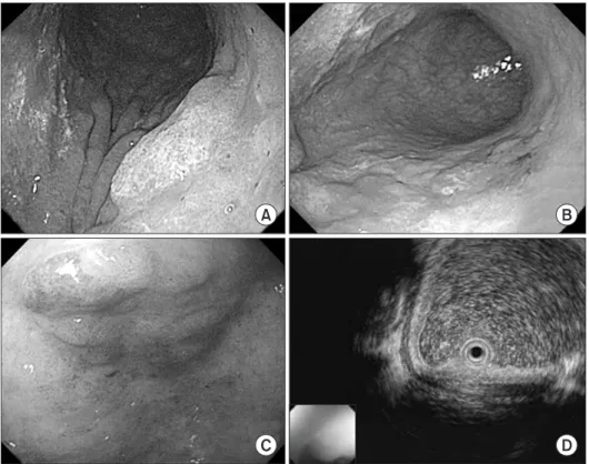 Fig. 1. Two centimeter elevated muco- muco-sal lesion was revealed as HGD on the  initial diagnosis of a 63-year-old male  (A)