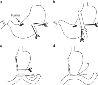 Fig. 1. Simplified illustration of the hand-sutured anastomosis.