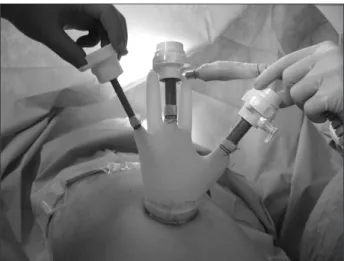 Fig. 1. Home-made single-port device was made from small wound  protractor and a surgical glove with conventional laparoscopic trocars.