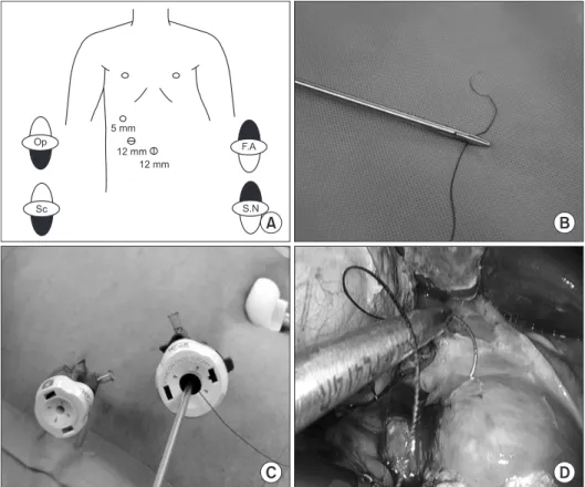 Fig. 1. (A) Trocar placements for lapa­
