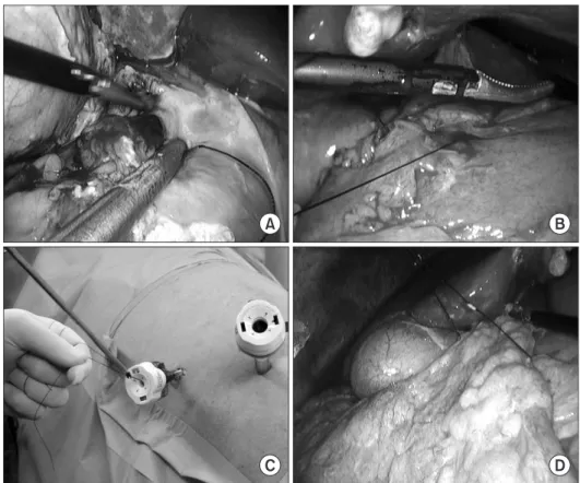 Fig. 2. (A) Extract the needle out of the  perforation site. (B) Extract the thread  by apply the principle of pulley