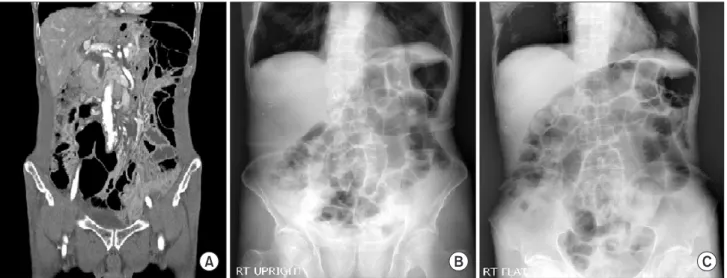 Fig. 1. (A) A preoperative abdominopelvic computed tomography scan and (B, C) simple abdominal x-rays showed no definite evidence of intesti- intesti-nal obstruction, except for mild paralytic ileus.