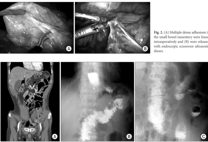 Fig. 3. (A) Abdominopelvic computed tomography and (B, C) upper gastrointestinal studies showed no stricture, intestinal obstruction, or passage  disturbance.