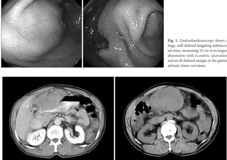 Fig. 1. Gastroduodenoscopy shows a  huge, well-defined fungating  submuco-sal mass, measuring 10 cm in its largest  dimension with eccentric ulceration  and an ill-defined margin in the gastric  antrum, lesser curvature.