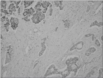 Fig. 4. Neuroendocrine carcinoma com ponents show strong immu- immu-nopositivity for chromogranin A (left upper), but negative  immunos-taining of adenocarcinoma component (right lower)  (Immunohisto-chemical stain, ×200).