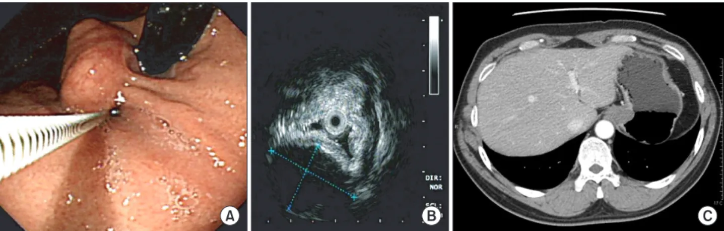 Fig. 2. Intraoperative view. (A) After careful division of lesser omentum from gastric cardia, 2.5 cm sized mass was identified at anterior and greater  curvature side of cardia