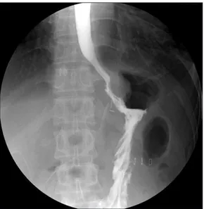 Fig. 3. Findings of upper gastrointestinal series on the 1 st  postoperative  day. A small indentation which was formed by anterior partial wrap  was shown at gastroesophageal junction.