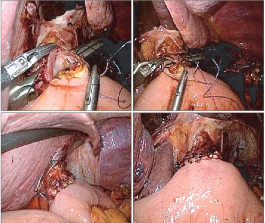 Fig. 2. Laparoscopic view for intracor- intracor-poreally hand-sewn  esophagojejunos-tomy.