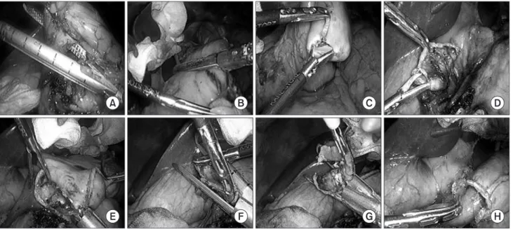 Fig. 1. Intracorpoeal gastroduodenostomy using linear staplers. (A) Intraoperative image showing resection of the duodenum