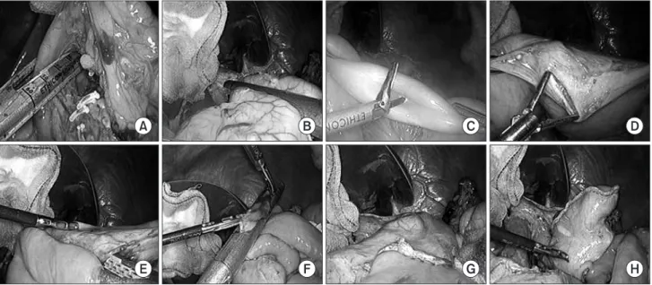 Fig. 2. Intracorporeal gastrojejunostomy using linear staplers. (A) Intraoperative image showing resection of the duodenum