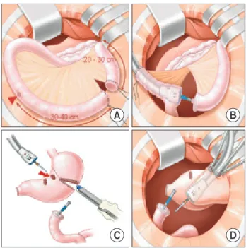 Fig. 1. Surgical procedure for Roux en Y reconstruction. (A) Division  of the proximal jejunum