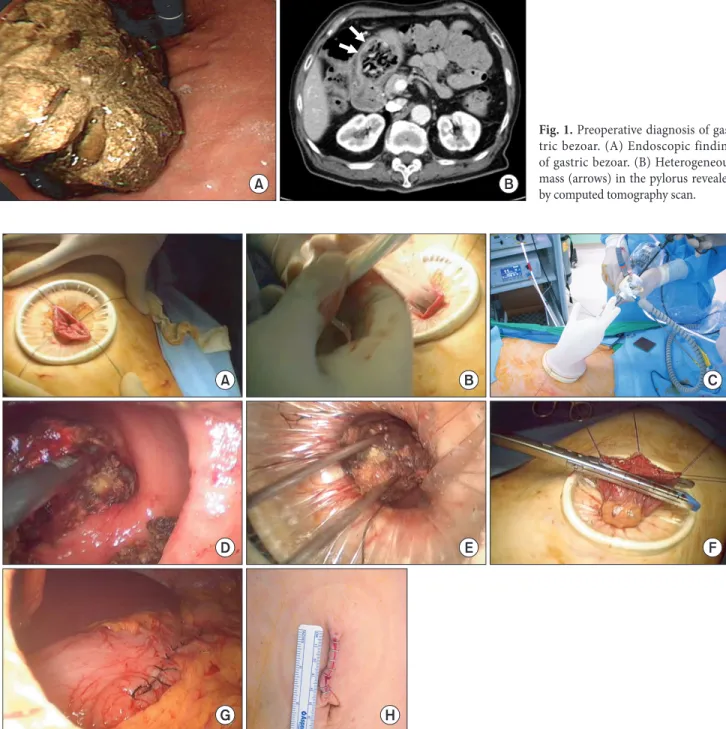 Fig. 1. Preoperative diagnosis of gas- gas-tric bezoar. (A) Endoscopic finding  of gastric bezoar