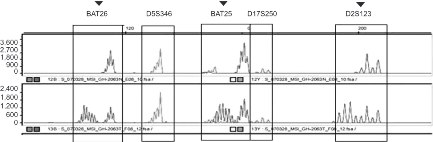 Fig. 1. An example of PCR analysis of microsatellite instability. Tumor DNA shows alterations of allele lengths in BAT25, BAT26, D5S346, D2S123,  and D17S250