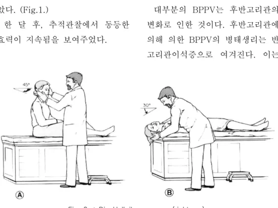 Fig.  2.  :  Dix-Hallpike  maneuver(right  ear).  환자가  반듯이  누웠을  때  머리가  침대의  위쪽으로  나올  수  있도록  걸터앉게  한다
