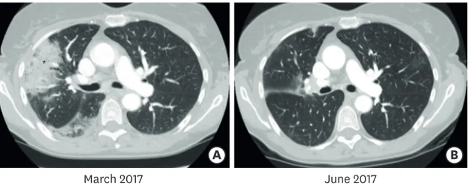 Fig. 4. During the first response-evaluation, CT revealed stable disease, but several unspecific opacities ( * ) in  the right lung (A)