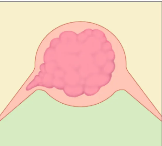 Fig. 1. Schematic diagram of microscopic parametrial involvement.