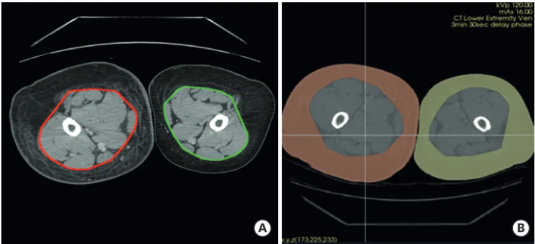 Fig. 1. Algorithmic quantitative skin and subcutaneous tissue volume measurements using CT images