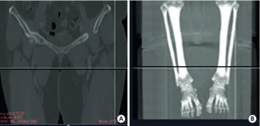 Fig. 2. Boundary levels of the algorithmic CT-based quantitative volume measurement. (A) The proximal level was  set at the point where the two legs separate on the CT image