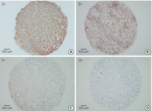 Fig. 1. The overview of staining intensities of the tissue array is shown (3+. 2+, 1+, and 0+), with an example each (A-D) for a membranous and/or for a  cytoplasmic staining pattern.
